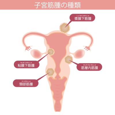 4種類の子宮筋腫を表した画像