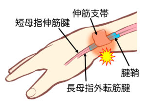 ドケルバン病（手首の腱鞘炎）の図